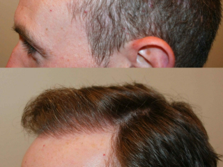 Extensive-Hair-Loss-2-1-scaled