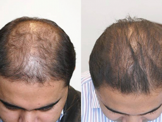 Extensive-Hair-Loss01