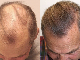 Extensive-Hair-Loss02