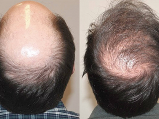 Extensive-Hair-Loss03