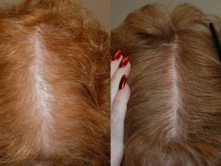 Female-Hair-restoration-1-1-1
