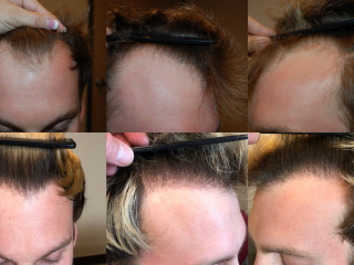 Hairlinefrontal-hair-loss-1-scaled
