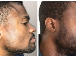 Beard rt side_pt18903