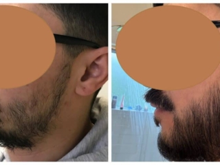 pt19142_left side beard