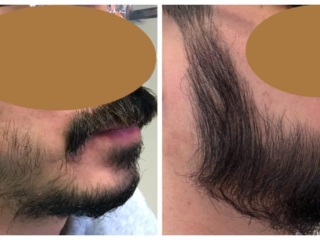 pt19142_right side beard