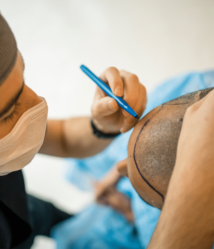 a surgeon marking a man’s head for surgical hair restoration