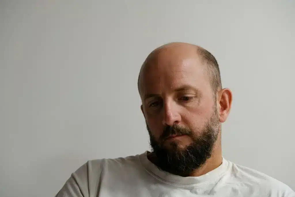 A sad middle-aged man with extensive scalp hair loss
